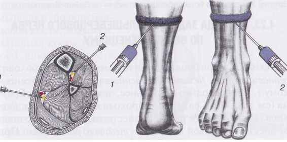 Блокада большеберцового и малоберцового нервов в области нижней трети голени по Брауну Блокада большеберцового и малоберцового нервов в области нижней трети голени по Брауну